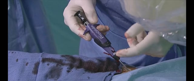 Access closure: ProGlide device