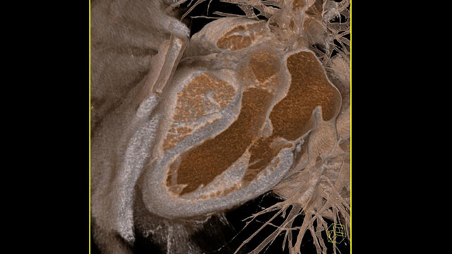 Valve-in-valve: TAVI for failing surgical aortic bioprostheses