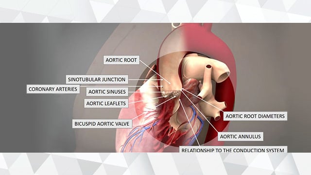 Anatomy of the aortic valvar complex