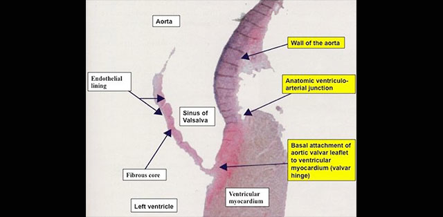 Anatomy: aortic annulus