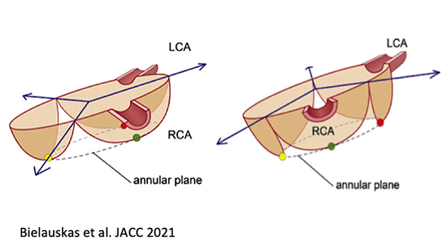 Cusp overlay implantation technique