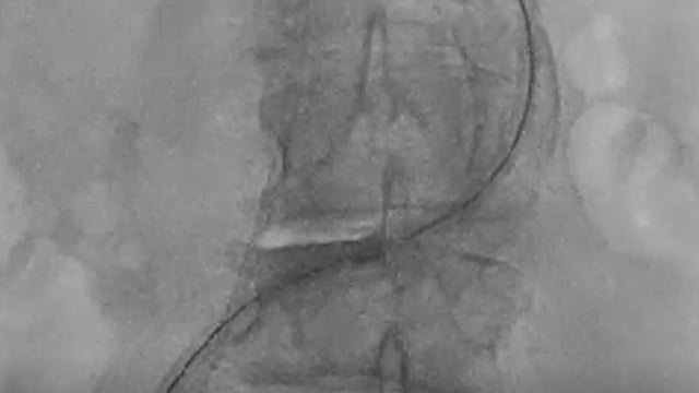 Expandable TAVR sheaths: which sheath fits which prosthesis?