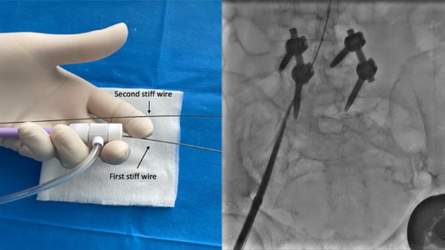 How to deal with ilio-femoral tortuosity during TAVI procedure:  the buddy wire technique to straighten the pathway