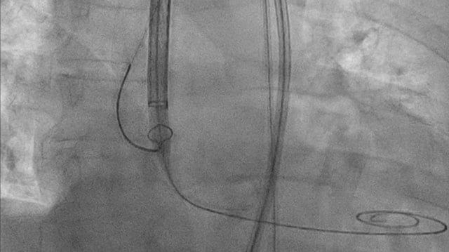How to snare a TAVI when crossing is too complex