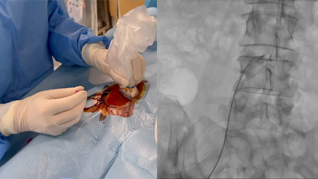 How to perform angiographic check after large-sheath removal in single access procedures