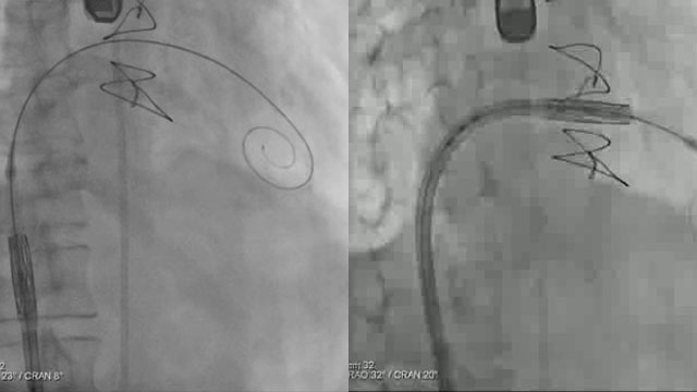 A simple maneuver to track the wire during a transseptal mitral valve-in-valve procedure