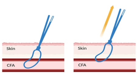 How to close vascular access with a combined suture-/plug-based strategy using one ProStyle and one Angio-Seal in TAVI