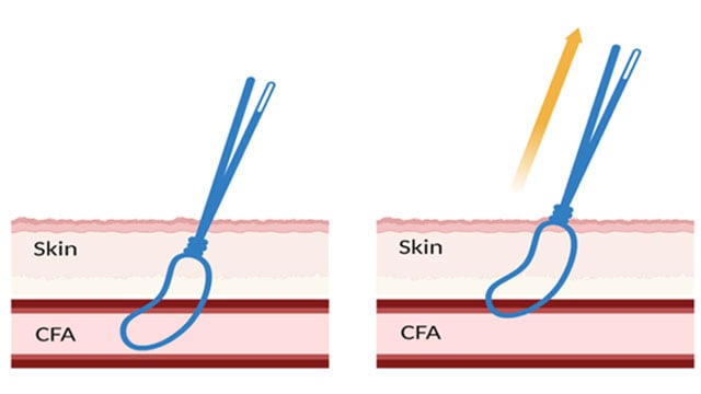 How to close vascular access with a combined suture-/plug-based strategy using one ProStyle and one Angio-Seal in TAVI