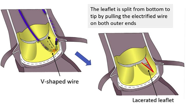 Performing BASILICA: a step-by-step guide to prevent coronary obstruction during TAVI