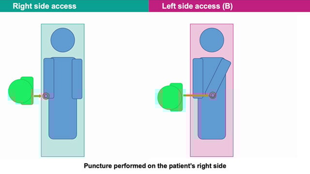 Distal Radial Access