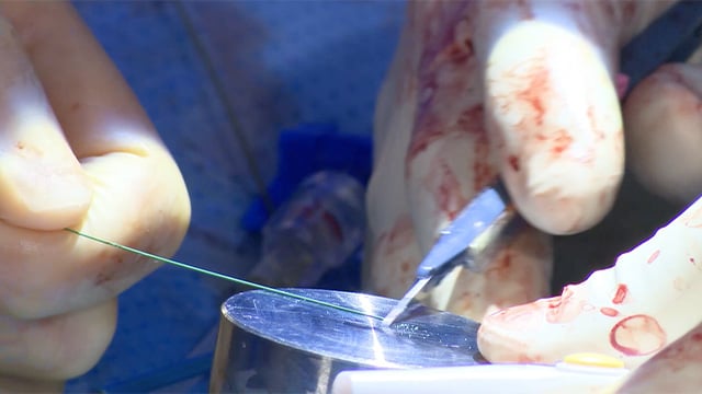 How to perform ELASTA-Clip: lacerating M-TEER devices to enable TMVR