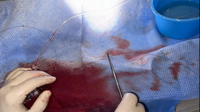 A novel bailout technique for the percutaneous extraction of an entrapped coronary guidewire beneath a crushed stent