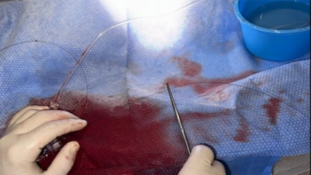 A novel bailout technique for the percutaneous extraction of an entrapped coronary guidewire beneath a crushed stent