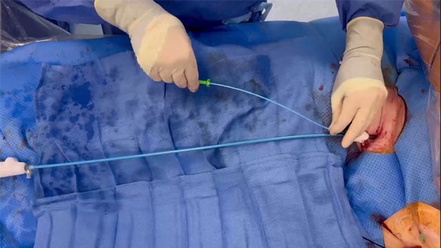 How to manage Safari wire entrapment during TAVI with Navitor THV