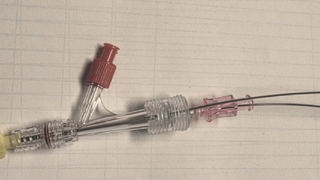 Self-made steerable catheter to cross the aortic valve in severe aortic stenosis