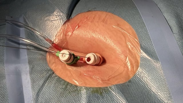 TAVI axillary access: simple & effective approach