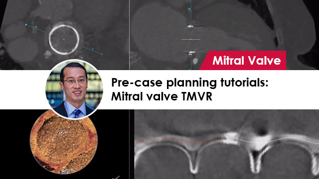 Pre-case-planning-tutorials-Mitral-valve-TMVR