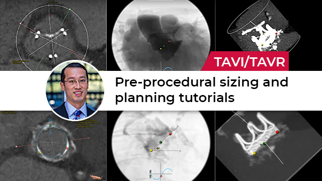 pre-procedural sizing and planning tutorials