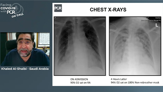 PCR on Call: a patient presenting with chest pain, dyspnoea and cough during the COVID-19 outbreak in Jeddah, Saudi Arabia