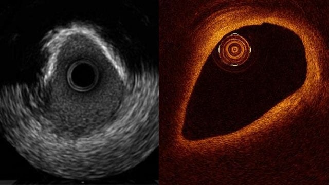 Imaging in Coronary Interventions