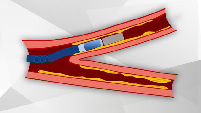 My toolkit: How to use a guide-extension catheter for stent delivery 