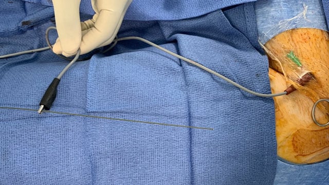 My Toolkit: How to use the guidewire for simple and efficient pacing during TAVI