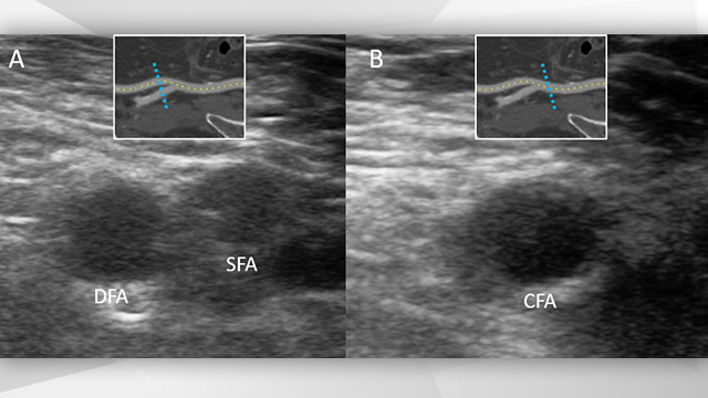 Ultrasound-guided puncture of the femoral artery for TAVI
