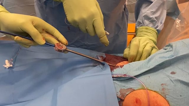 How to improve the effectiveness of hemostasis of large bore arteriotomy using a combined approach of suture- and plug-based closure devices