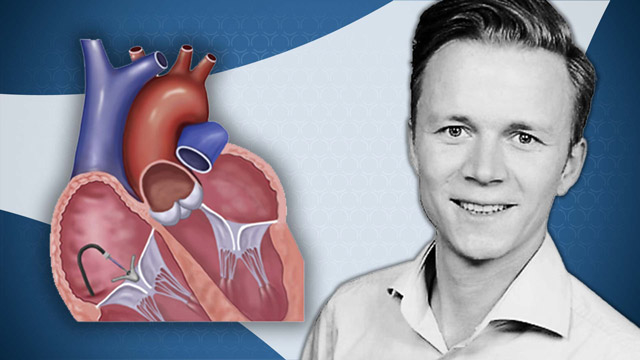 Hemodynamic implications of TTVI