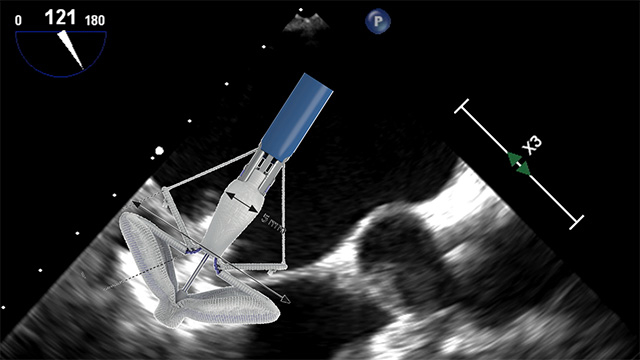 Advanced Course on Transseptal Puncture – View the programme