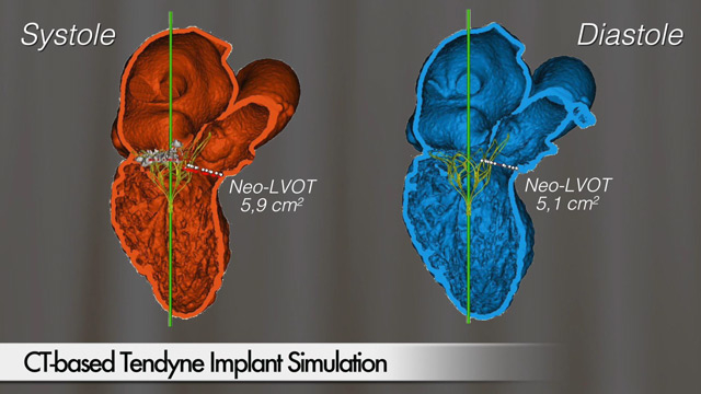 CT-Based Tendyne Implant Situation