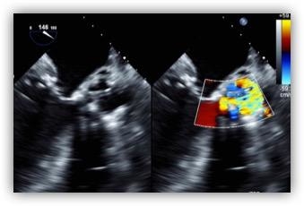 Best Case from PCR London Valves 2018: Dr. Z. Wang