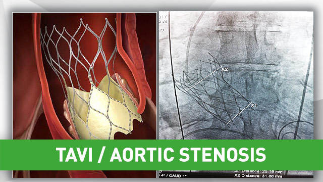 Patient with symptomatic AS using the THV Portico device