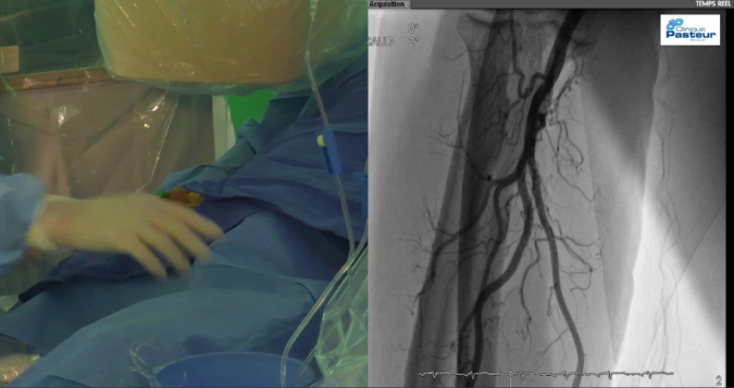 Radial arteriography
