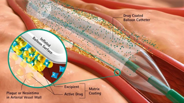 Interventions with drug-coated balloons – a PCR Statement
