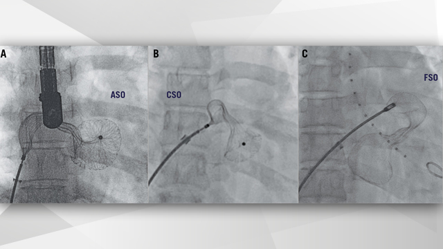 EuroIntervention: comparison of 3 atrial septal occluder designs
