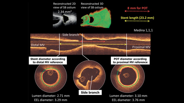 Joint consensus on the use of OCT in coronary bifurcation lesions by the European and Japanese bifurcation clubs