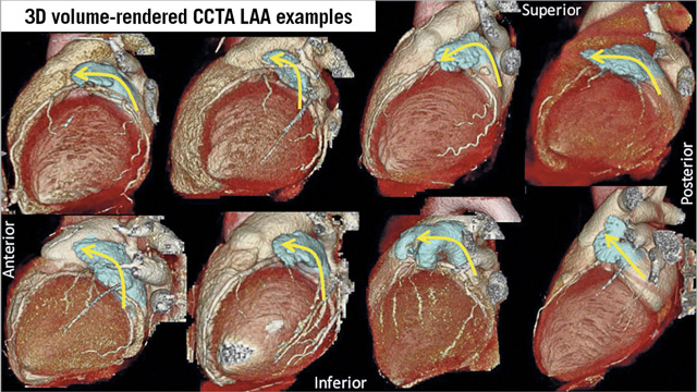 EuroIntervention - Consensus paper on LAA occlusion
