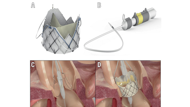 EuroIntervention: First-in-human TF J-Valve system