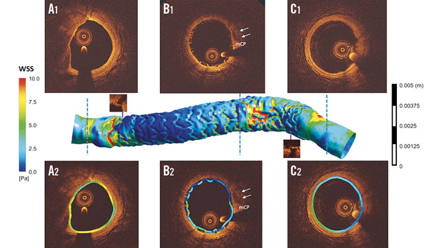 EuroIntervention: Wall shear stress in BRS