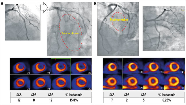 EuroIntervention: Anatomical attributes of clinically relevant diagonal branches in patients with left anterior descending coronary artery bifurcation lesions