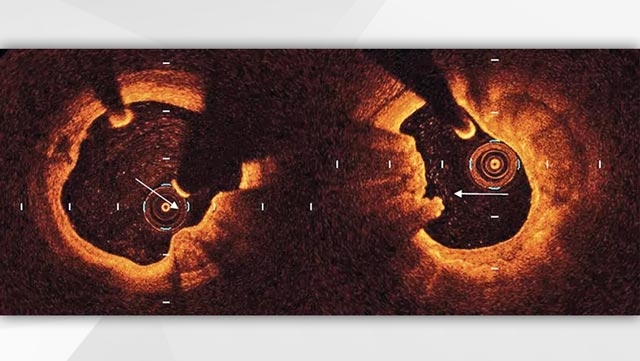 EuroIntervention - Clinical outcomes of calcified nodules detected by optical coherence tomography: a sub-analysis of the CLIMA study