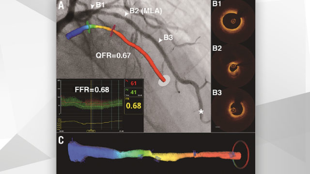 EuroIntervention: Comparison between OFR and QFR