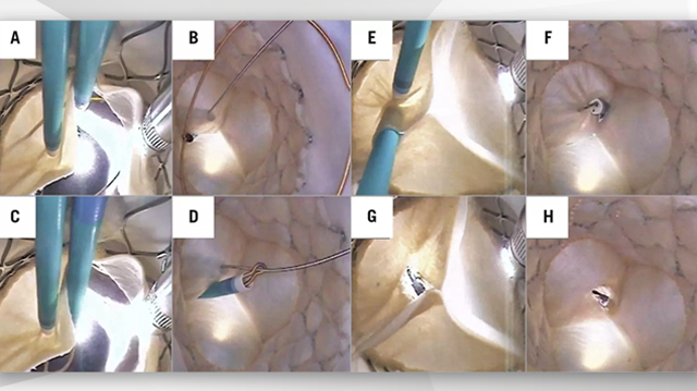 EuroIntervention: Direct visualisation BASILICA technique post TAVR enhance coronary flow