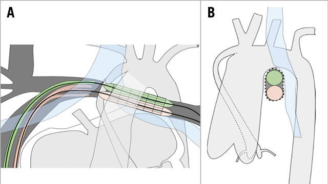EuroIntervention: Oval LPA stenting to prevent LMB compression