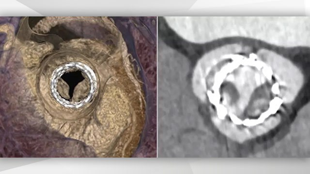 EuroIntervention: Predictors of haemodynamic structural valve deterioration following transcatheter aortic valve implantation