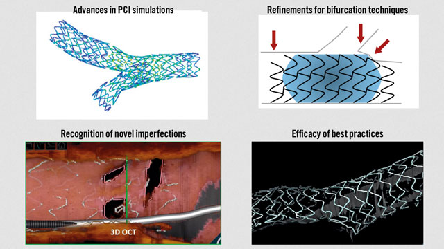 EuroIntervention: PCI for bifurcation coronary lesions: the 15th consensus document from the European Bifurcation Club