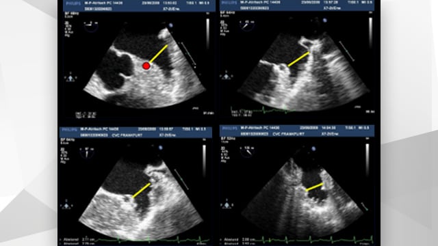 Left atrial appendage occlusion