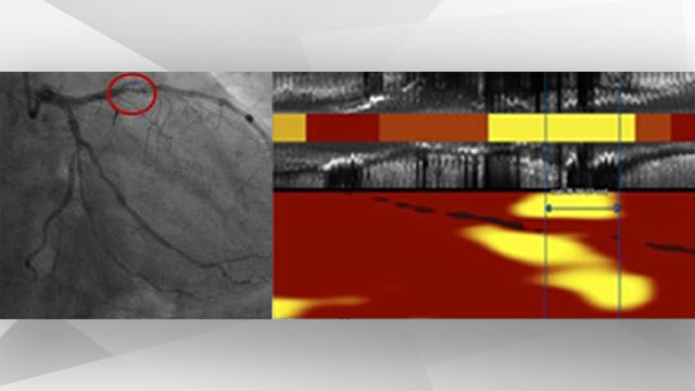 CCT and NIRS imaging illustrating plaque consistency in a culprit lesion