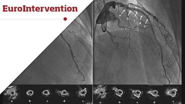 Coronary lithotripsy for the treatment of underexpanded stents: the international multicentre CRUNCH registry